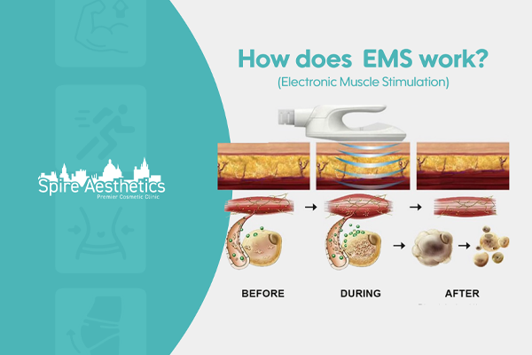 EMS treatment for post pregnancy weight loss treatment Soham