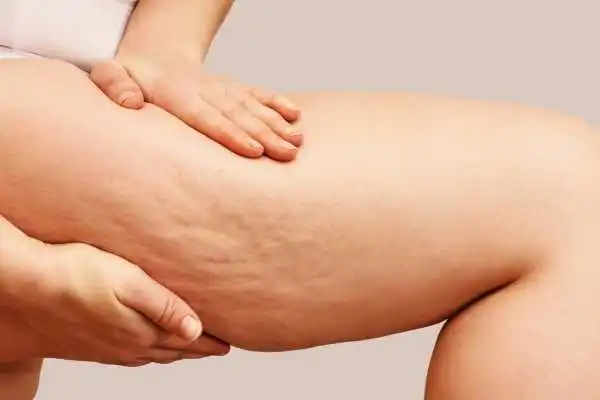Image of woman showing leg with cellulite Soham