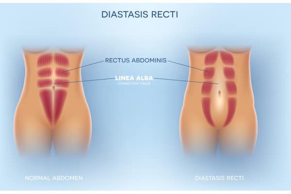 What Non-Surgical Options Are Available for Diastasis Recti Soham?