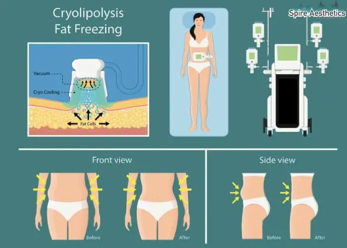 Fat freezing treatment Soham benefits for competitions to remove stubborn fat deposits.
