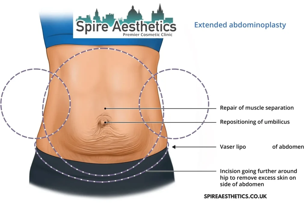 Understanding Loose Skin After Gastric Band Soham Surgery and HIFU Treatment 
