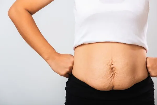 Image of a woman's stomach after weight loss with sagging skin following a gastric band Soham