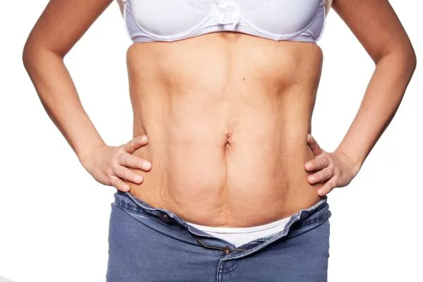 sagging skin on woman's stomach after weight loss injections Soham