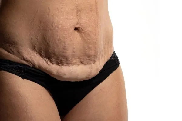 Image of womans stomach after weight loss injections Soham showing saggy skin