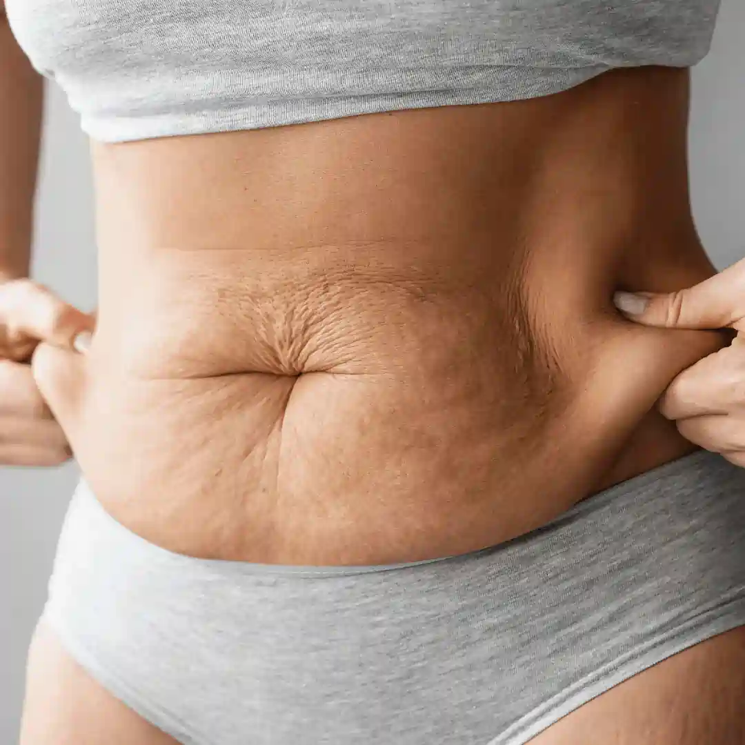 Is It Normal to Have Loose Skin After Pregnancy Soham?