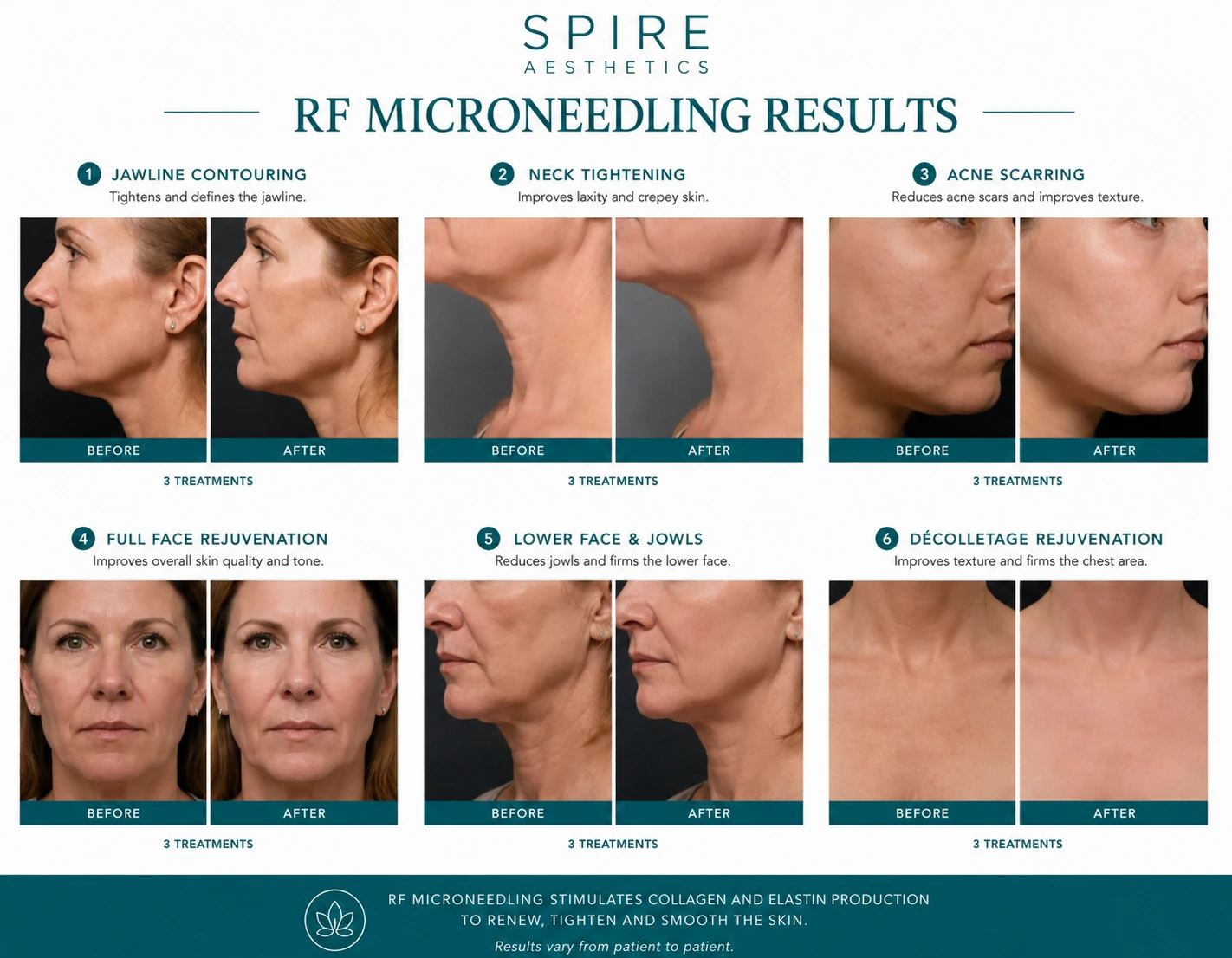 RF Microneedling Skin tightening Soham results
