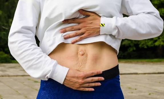 When Could Diastasis Recti Be the Missing Piece of the Puzzle Soham?