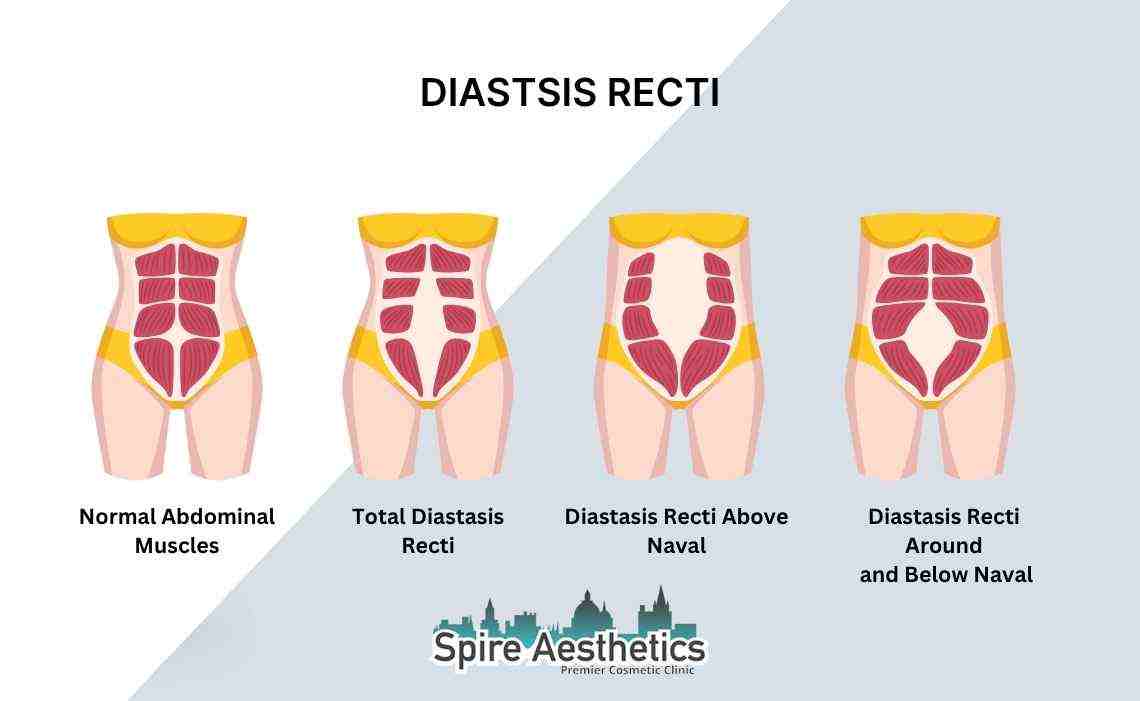 Is Non-Surgical Diastasis Recti Treatment Right for You? Common Concerns Answered Soham
